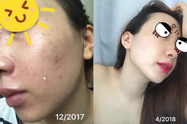 Mặt sưng phù vì dưỡng da bằng kem trộn