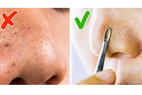 “Tiêu diệt” mụn đầu đen trên mũi bằng 4 cách đơn giản