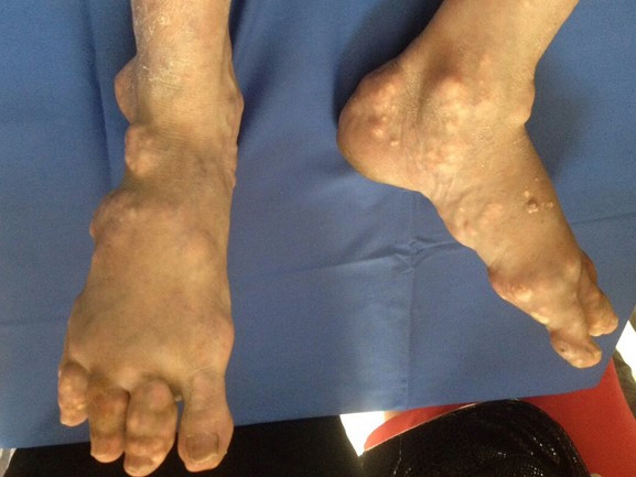 Tay chân biến dạng vì tự trị bệnh gout trong 10 năm