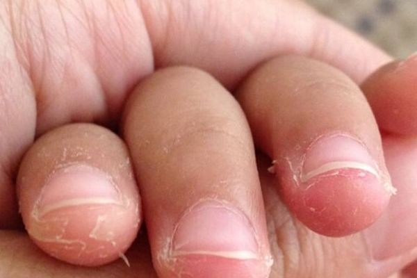 Vì sao da đầu ngón tay bị bong tróc?