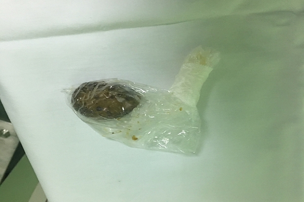 Bị tắc ruột vì nuốt một đoạn nấm đông cô