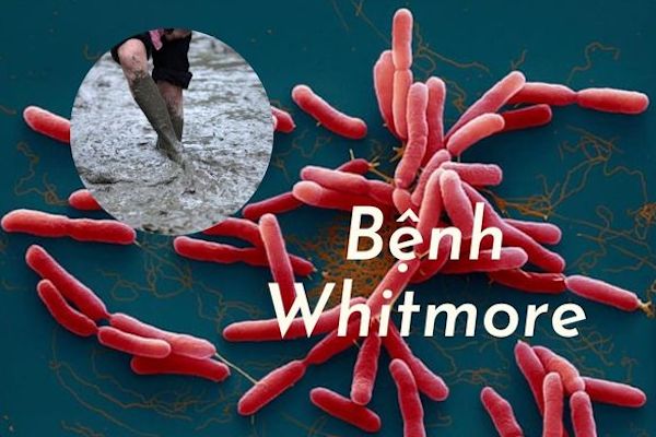 Thanh Hóa, Đắk Lắk bất ngờ phát hiện 3 ca mắc Whitmore