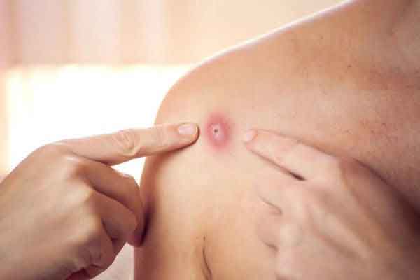 Dễ nhầm bệnh đậu mùa khỉ với giang mai, Mỹ tìm ra 2 biến thể, giới chức y tế kêu gọi xét nghiệm
