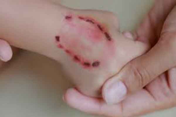 Kinh hoàng căn bệnh có tỉ lệ tử vong 100%