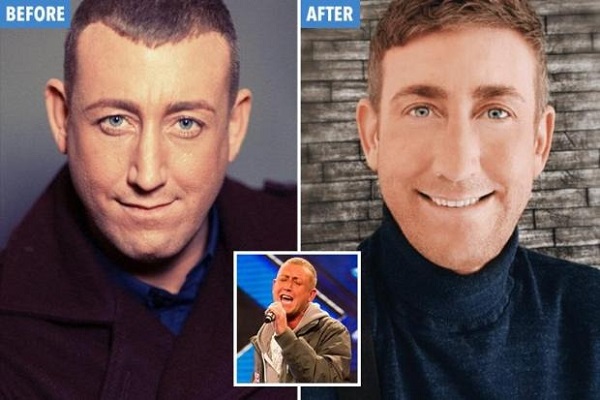 Lý do khiến nam ca sĩ nổi tiếng phải phẫu thuật thẩm mỹ 20 lần trong 7 năm?