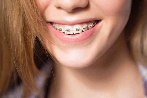 Cẩm nang hữu ích nếu bạn có ý định chuẩn bị đi niềng răng