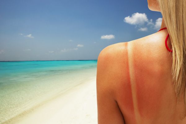 Giải cứu làn da cháy nắng mất thời gian bao lâu?