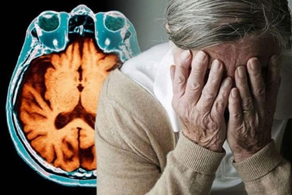 Đột phá mới giúp điều trị bệnh Alzheimer