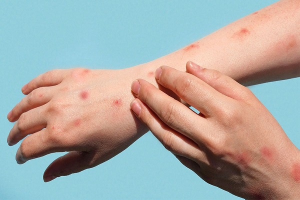 Chủ động phòng chống đậu mùa khỉ trước ca bệnh đầu tiên tại Việt Nam