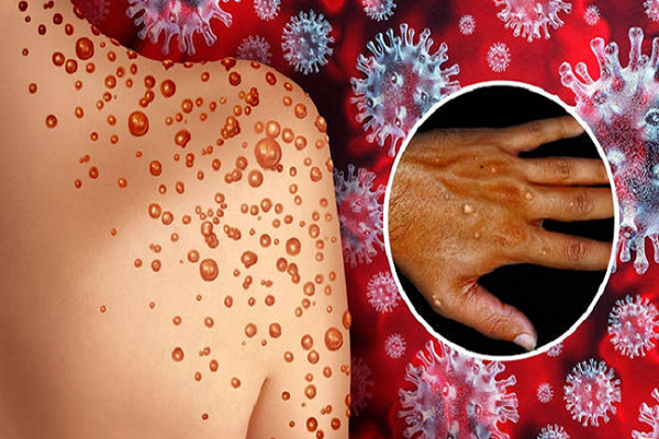 Các biện pháp phòng tránh bệnh đậu mùa khỉ ở vật nuôi trong nhà