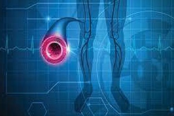 Phương pháp điều trị bệnh động mạch ngoại vi bằng công nghệ LimFlow