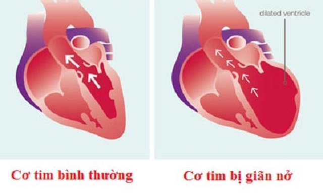Bệnh ung thư của trái tim