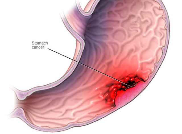 Những dấu hiệu cho thấy bạn có thể đã mắc ung thư dạ dày