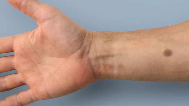 Phát hiện ung thư sớm bằng việc cấy “nốt ruồi” dưới da