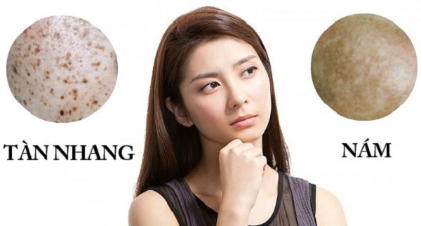 Nám da và tàn nhang khác nhau như thế nào?