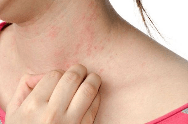 Phát hiện mới về bệnh viêm da dị ứng