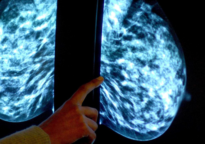Có thể không cần hóa trị với bệnh nhân ung thư vú