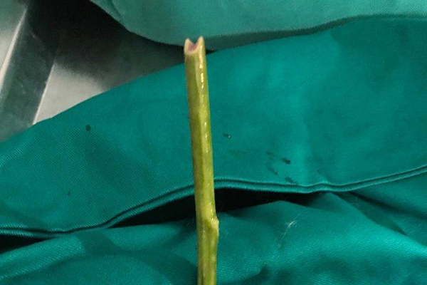 Hy hữu: Một người phụ nữ tự phá thai, để quên cái que trong cơ thể