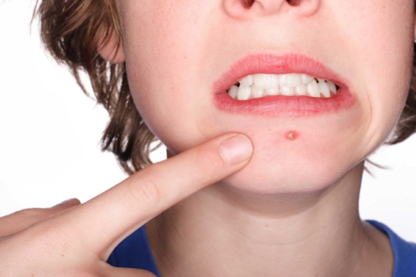 Công bố lý do chưa ai biết gây nên mụn