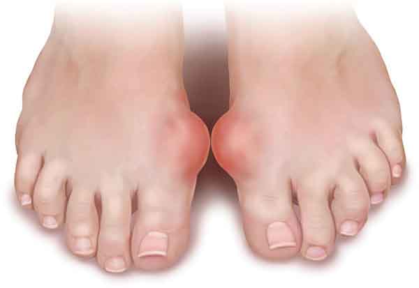 Bị gout nên làm bạn với những thực phẩm nào?