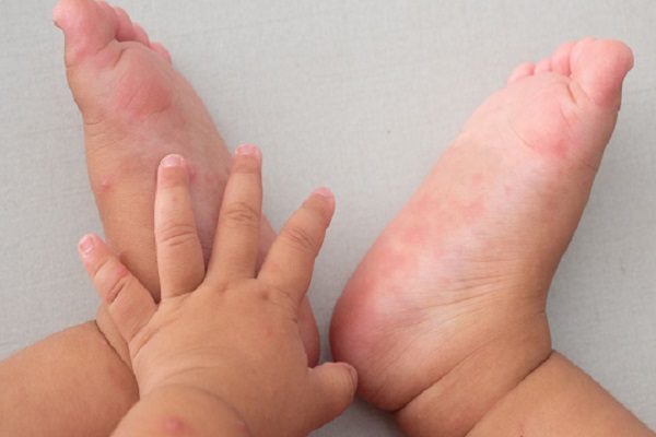 TP.HCM khẩn cấp báo động gia tăng bệnh tay chân miệng nặng