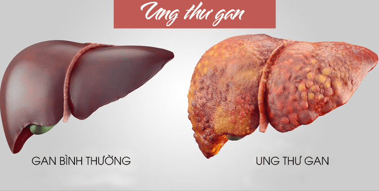 Có thể chống được ung thư gan từ một loại protein mới