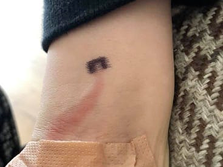 Nếu con có vệt đỏ trên tay, các mẹ hãy cảnh giác và nên đưa đi khám ngay