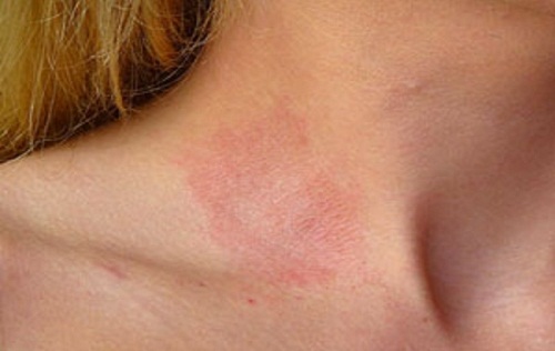 Căng thẳng có thể khiến bệnh viêm da trở nên nghiêm trọng hơn